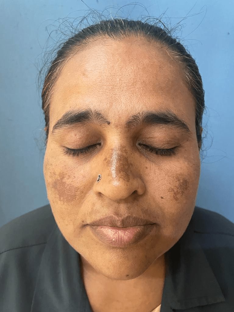 🟣𝘾𝙇𝙄𝙉𝙄𝘾𝘼𝙇 𝙎𝘾𝙀𝙉𝙀𝙍𝙄𝙊:-

📝A 38yr old ♀️ presents with greyish pigmentation over cheeks & nose.

#Diagnosis❓

#medx
#MedTwitter
#medEd image :@Venkat_centre