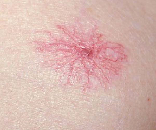 🟣𝘾𝙇𝙄𝙉𝙄𝘾𝘼𝙇 𝙎𝘾𝙀𝙉𝙀𝙍𝙄𝙊:-

A patient of Chronic #liver_disease presents with numerous vessels radiating from centre on his abdomen.

What is the positive finding 🤔🤔

#medx #MedTwitter  #medEd