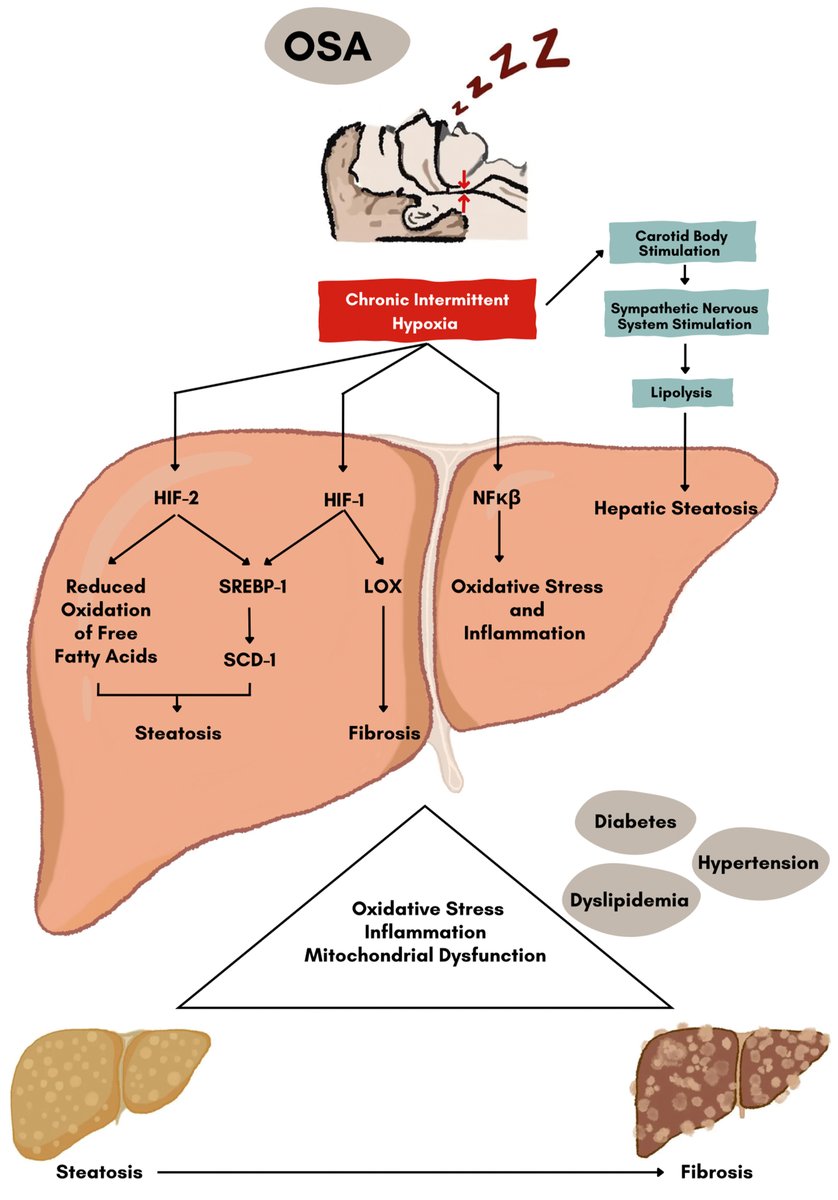 Read the Journal of Clinical and Experimental Hepatology original article: Evaluation of Hepatic Steatosis and Fibrosis Using Transient Elastography in Patients With Obstructive Sleep Apnea - spkl.io/601840cau