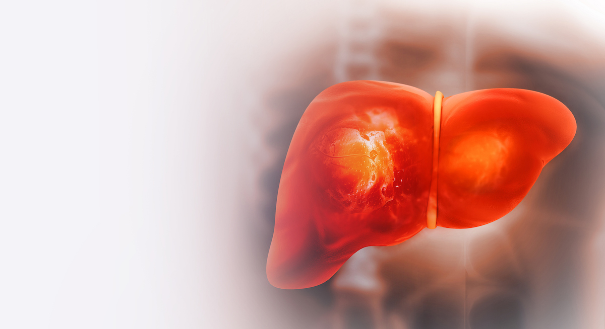 In a new study, a @yalepathology team has identified a possible target for #treating #obesity-induced #livercancer. Researchers say inhibiting a molecule called fatty acid binding protein 5 (FABP5) could block #tumor progression in many cases. #medtwitter brnw.ch/21wJd6Q