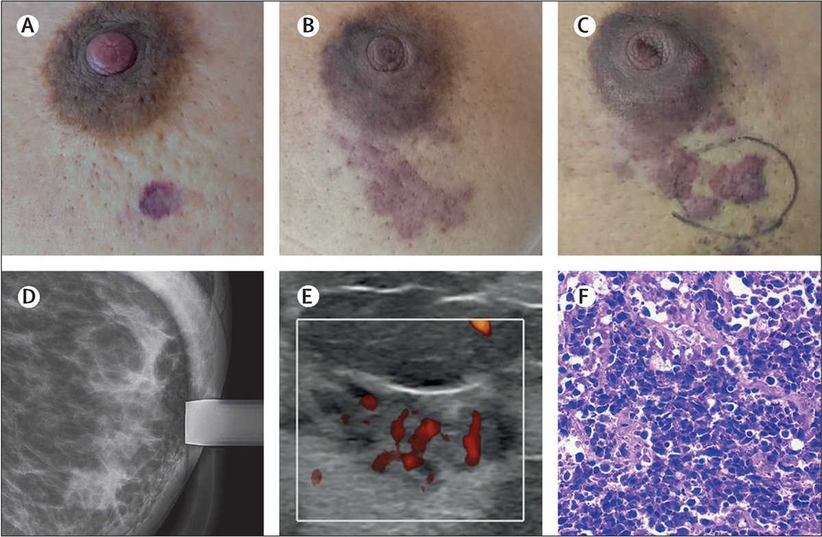 New #TLClinicalPic quiz: “Breast erythema, swelling, and a purple skin plaque in a patient with a history of ductal carcinoma' Test your medical knowledge & diagnostic skills 👇 hubs.li/Q02v8MN_0