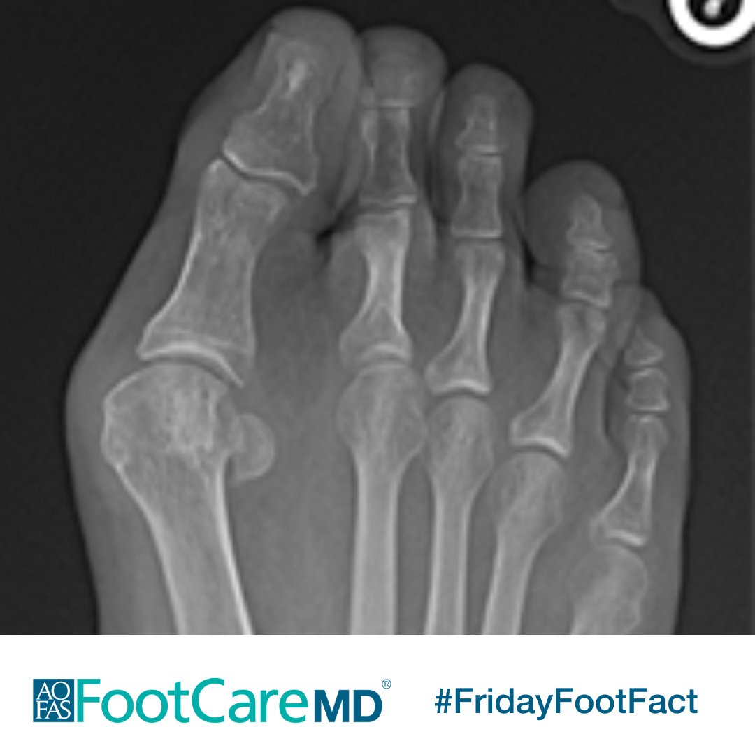 In minimally invasive bunion surgery, foot & ankle orthopaedic surgeons correct the bunion with specialized instruments and very small incisions. Recovery after surgery is often faster compared to open procedures. Learn more at #FootCareMD: ow.ly/6xM050RnwlV #FridayFootFact