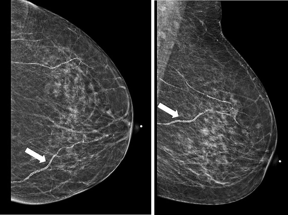 🏥'Assessing breast arterial calcification in mammograms and its implications for atherosclerotic cardiovascular disease risk,' new work from Michele Drotman, @KemiMDRad, Allison Levy, & @jpenamd in 'Clinical Imaging' (@CI_Journal), can be read here👉tinyurl.com/3ewxpxtj