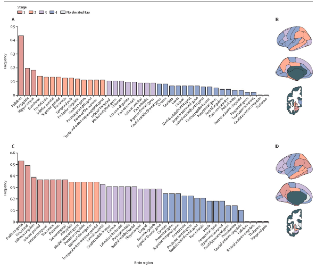 Ances BioImaging Laboratory (@anceslaboratory) on Twitter photo In our latest collaboration with <a href="/abc_ds_/">Alzheimer Biomarkers Consortium — Down Syndrome</a> and DIAN, we compared tau pathology in Down Syndrome and Autosomal Dominant Alzheimer Disease (AD). doi.org/10.1016/S1474-… (1/6) In our latest collaboration with <a href="/abc_ds_/">Alzheimer Biomarkers Consortium — Down Syndrome</a> and DIAN, we compared tau pathology in Down Syndrome and Autosomal Dominant Alzheimer Disease (AD). doi.org/10.1016/S1474-… (1/6)