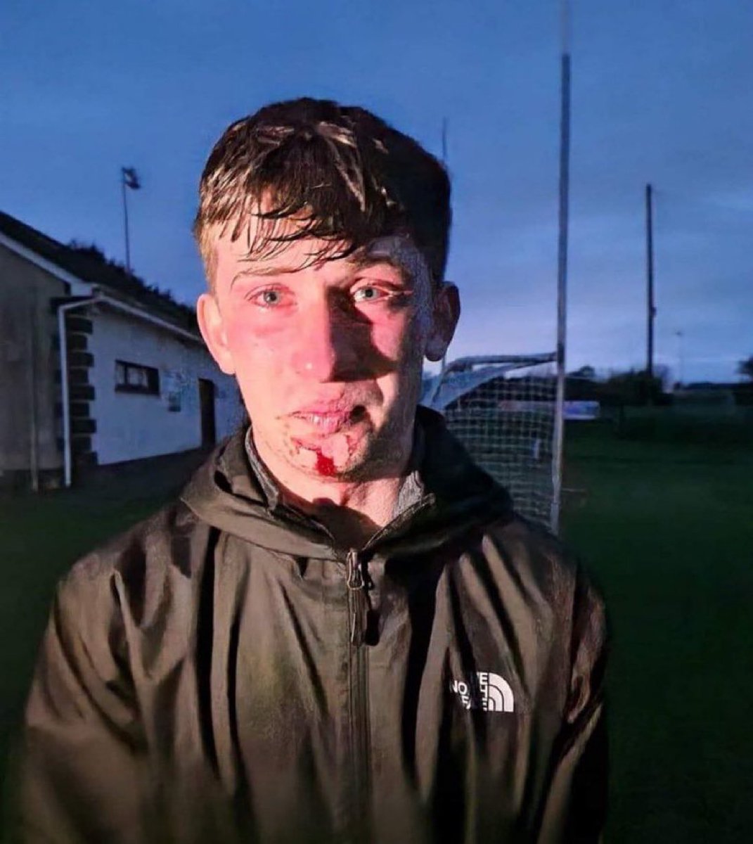 This Irish teenager was pepper sprayed multiple times giving him visible swollen eyes; he was beaten and hit on the face several times with police baton. Reports say his teeth were cracked and other facial injuries. His crimes were attending a peaceful demonstration against