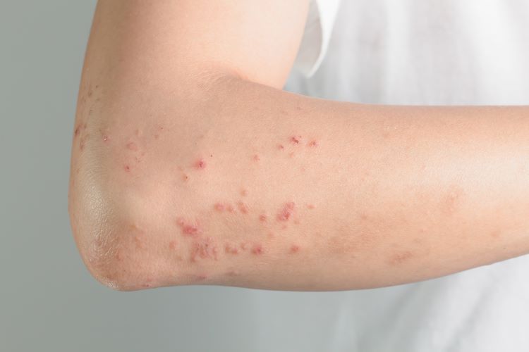Certain atopic dermatitis patients can strive for both little to no itch and clearer skin with upadacitinib, topline study results suggest. @abbvie #drugdevelopment #EPRTalks