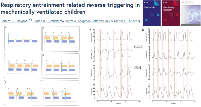 📕Article Alert📕
Respiratory entrainment related reverse triggering in mechanically ventilated children 🫁🧒
#OpenAccess #ChildrensHealth #RespiratoryResearch

Read the Article: doi.org/10.1186/s12931…
