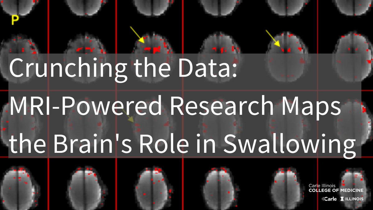 New #ILLINOISmed research is mapping the brain's role in swallowing. The work is aimed at improving the diagnosis & management of swallowing impairment, particularly for patients w/ Parkinson’s or recovering from a stroke. ➡️ medicine.illinois.edu/news/cruncing-… 🔶 @UofIllinois @BeckmanInst