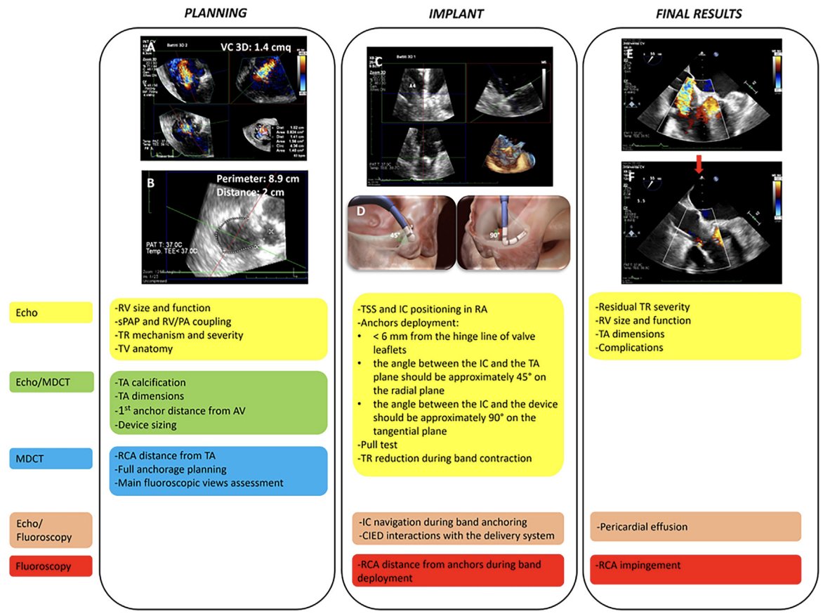 Transcatheter TV annuloplasty relies on multimodality imaging ⦿Cardiac CT assesses: annular size, calcium, tissue quality & hinge pt to RCA distance for anchoring ⦿ TEE: 3D volume TV sizing; Biplane TEE & MPR align implant @JournalASEcho @ASE360 Link→ bit.ly/49TcRuT