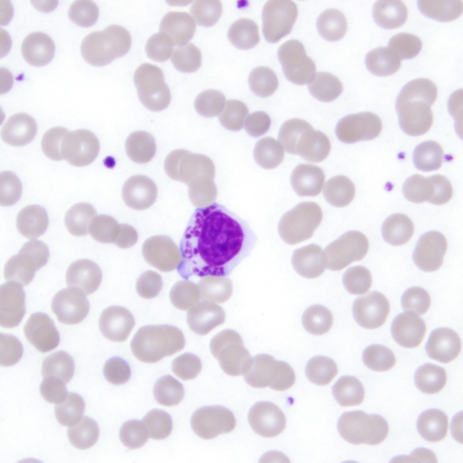 #hemepath marginal zone lymphoma with cytoplasmic granules