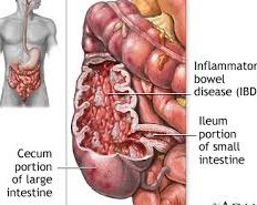 Most doctors say to a patient w/ IBS, Crohn's DZ, or ulcerative colitis 'eat more fiber'  

My suggestion: eat as little fiber as possible, preferably none for 8-12 wks  

Remove the abrasiveness of plant fiber & let the bowel heal inflammation #IBS #colitis #crohns #carnivore