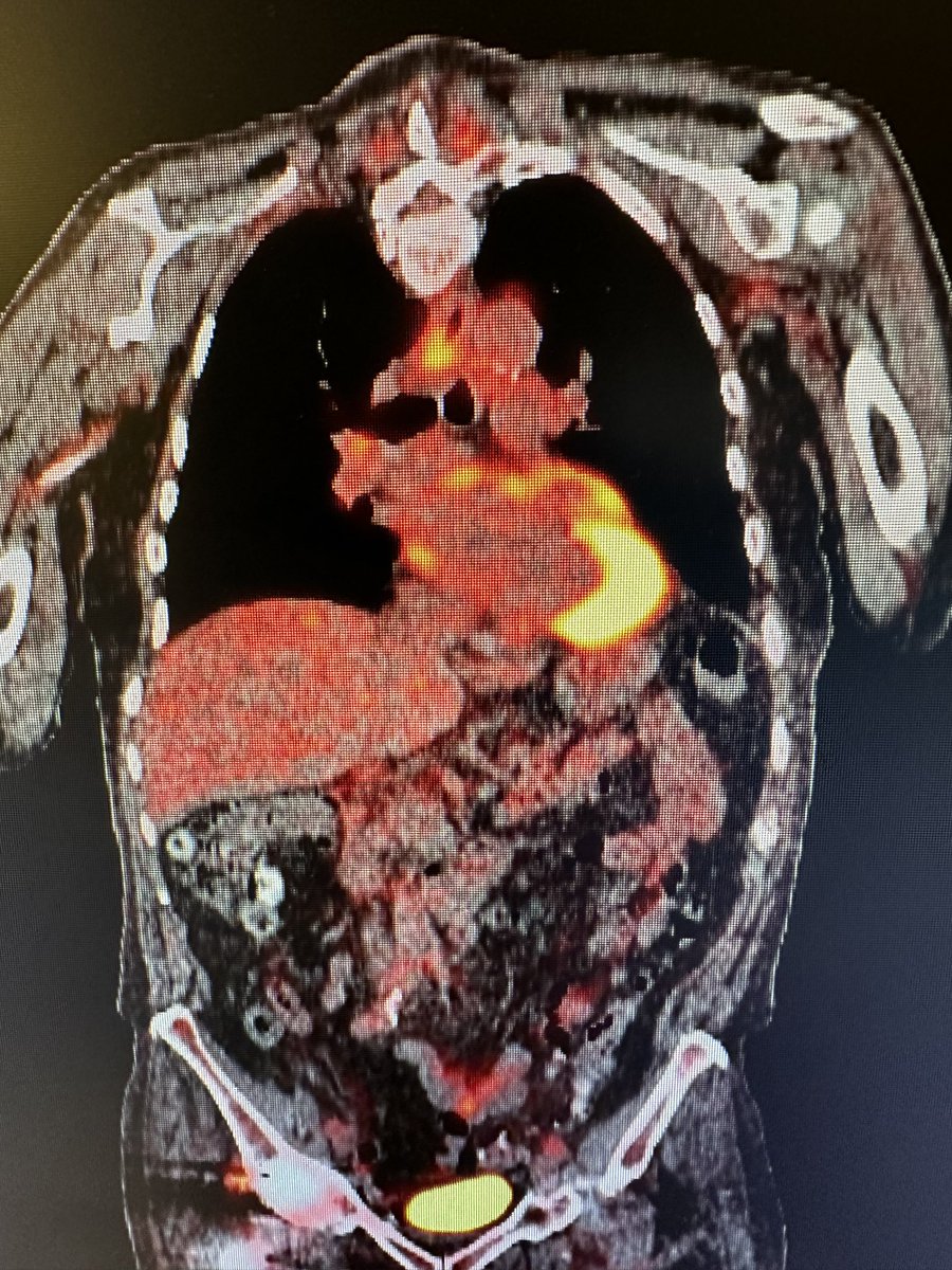 Thoughts on Esophageal cancer with RLN paralysis? 
70 year old male, mid Esoph adenoca left RLN paralysis- neoadj chemo xrt
Robo Ivor Lewis and Bilateral RLN dissec ypT0N0
@LFerri123 @ISDE_net @MagnusNsurgonc @JournalofGISurg @SSATNews @EwenGriffiths @ElliotServaisMD