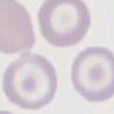 What is this cell called?
And in which poisoning will you see these types of cells?

#Neetpg2024 #MedX #MedTwitter