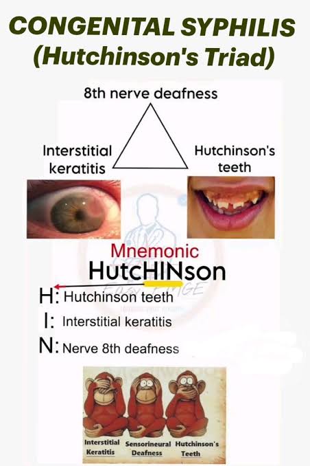 @modernHealthMe Hutchinson's triad is a common pattern of presentation for late congenital syphilis, and consists of three phenomena: interstitial keratitis, malformed teeth (Hutchinson incisors), and eighth nerve deafness. There may also be a deformity on the nose known as saddle nose deformity