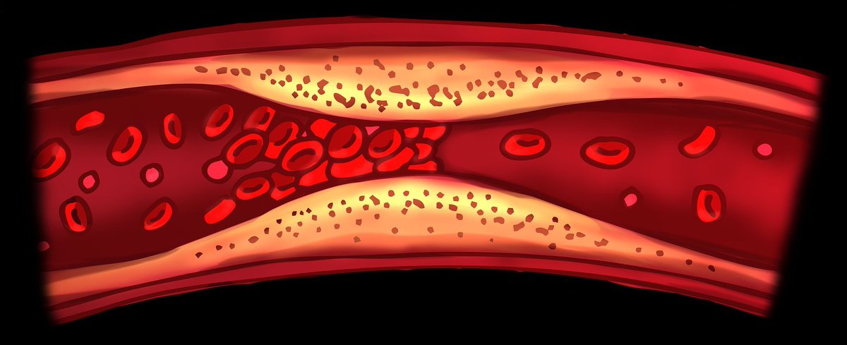 Venous thromboembolic event Risk study in 1854 SLE pts vs controls (12,107) from 1985–2015 in W Australia. VTE affected 12.8% SLE pts; 6 fold higher than controls (RR 6.6). Risk factors: aPL(aHR 4.24), serositis (2.7), nephritis (1.75), low Plts (1.65) buff.ly/3vYMo1e