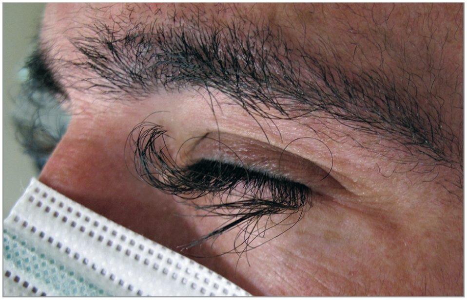 Case report describes an adult male patient with a severe acneiform eruption on his chest and back. On physical exam, he was noted to have diffuse acneiform papules on the trunk and was incidentally noted to have anomalous elongation of the eyelashes. ja.ma/4d5SYDL