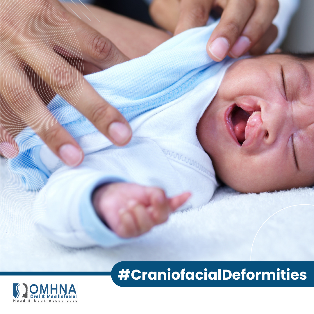 Craniofacial deformities extend far beyond cleft palates, encompassing a wide range of conditions that affect the skull, face, and jaw. 

Learn more about this unique surgery option by visiting our website to see how we transform lives : omhna.com/services/crani… 

#CranioSurgery