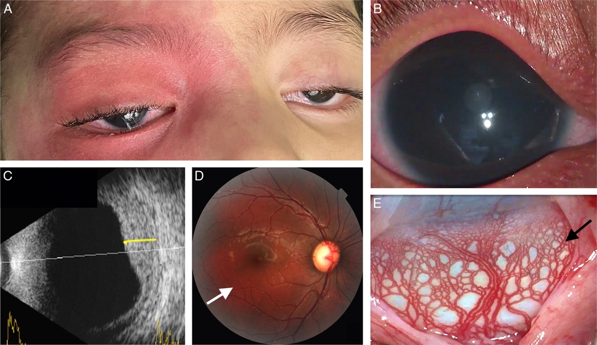 Ophthopedia Update: Treatment Outcomes of Primary Combined Trabeculotomy With Trabeculectomy in Early Onset Glaucoma With Sturge-Weber Syndrome dlvr.it/T63VFd #Ophthalmology #Eye #Ophthotwitter