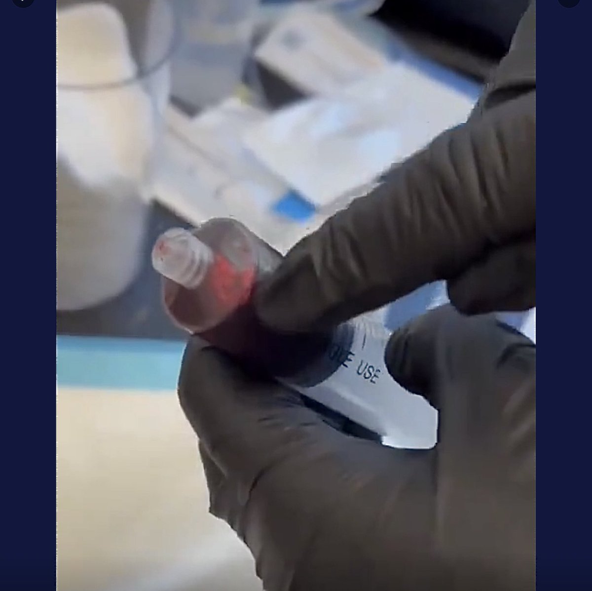 Blood Samples from 2 Confirmed VaxInjured patients.
Call it “Mudblood.”
————————————————
Sample 1️⃣ From from a portacath and was a waste sample in syringe during port access.
Sample 2️⃣ Drawn from peripheral vein (arm vein)
Why call it Mudblood? 
Test results say it all:
•…