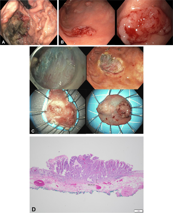 At the Focal Point, Civitarese et al apply the 'Use of endoscopic submucosal dissection in a patient with synchronous and metachronous gastric cancers secondary to MSH2-related Lynch syndrome.' giejournal.org/article/S0016-…