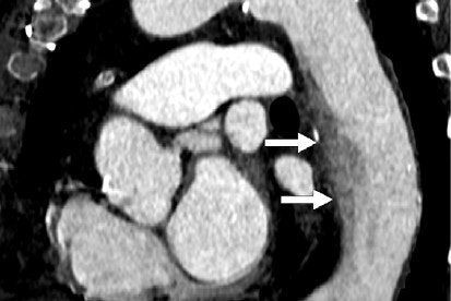 Understanding CT flow artifacts is key to better disease diagnosis #radiology #CT @MIRimaging buff.ly/3Wfl0GI