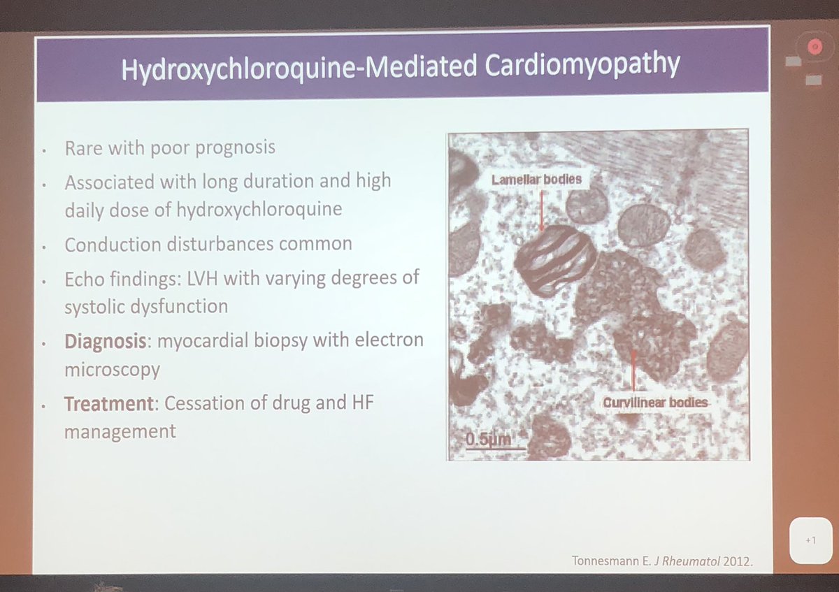 SLE pt on HCQ for yrs presenting w/ symptomatic new HF w/ conduction abnormality. Include HCQ-mediated cardiomyopathy in your differential. Dx: Myocardial biopsy Mgmt: Stop HCQ, start GDMT Great teaching points by @Bweber04 @CardioNerds @NYUCVDPrevent @garshick