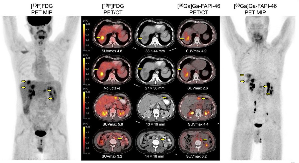 ⚠️Beware of False-Positive Uptake on FAPI and FDG PET even 3 months After Chemotherapy in Non-Seminomatous Germ Cell Tumor ! It can be just fibronecrotic tissue. 
#PET #FAPI #FDG #theranostics #CancerResearch 
jnm.snmjournals.org/content/early/…