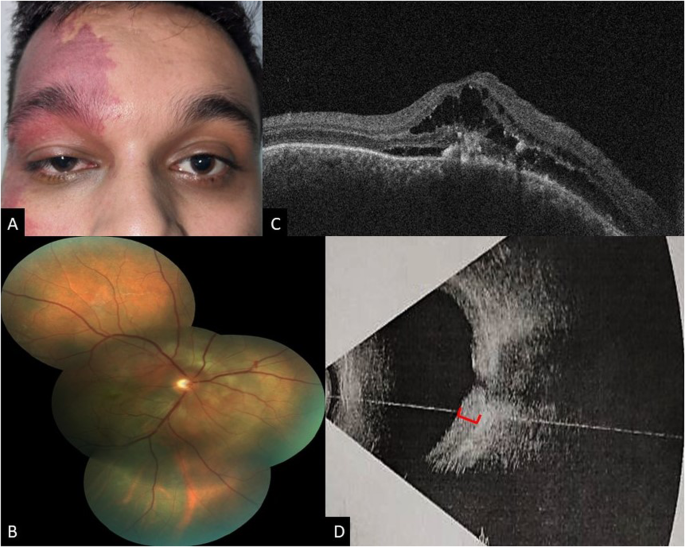 Ophthopedia Update: The Incomplete Sturge-Weber dlvr.it/T649Pz #Ophthalmology #Eye #Ophthotwitter