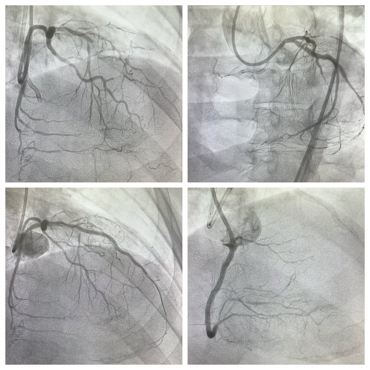 44👨🏻‍🦰, ischemic CMP. LCx STEMI w/ CS in September/23 on top of RCA/LAD CTOs. EF 30s. LAD was recanalized during LCx PPCI. LAD Re-occluded. Very symptomatic. Was referred for CABG but turned down unfortunately. Now LAD IS-CTO antegrade PCI & RCA CTO PCI using retrograde approach.…