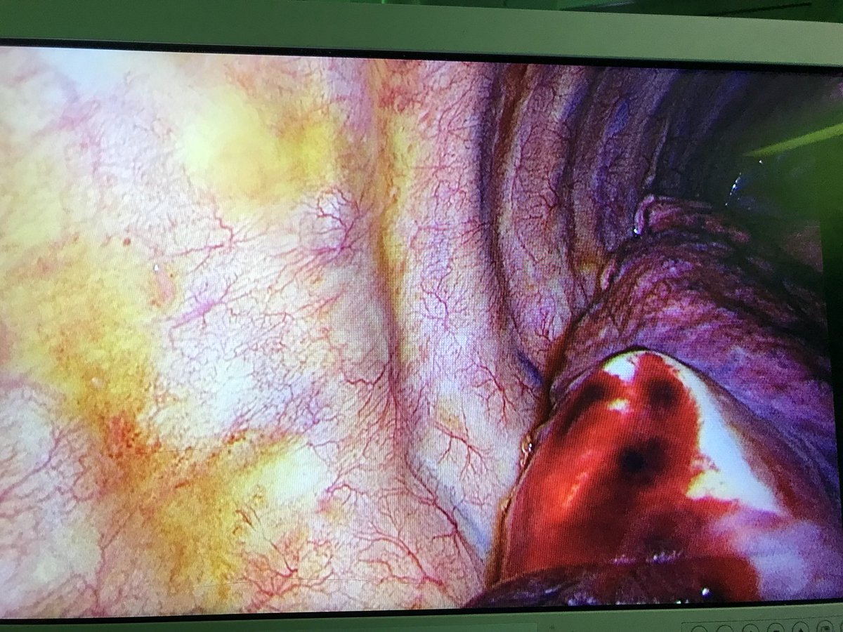ElliotServaisMD's tweet image. Craziest thing I’ve seen in chest

Patient transferred to us after chest tube placed at outside ED for spon pneumothorax 1 week prior 

VATS for persistent air leak &amp;amp; found finger tip of glove embedded in lung

No prior chest procedures

ED procedure note - no issues noted
🤯
