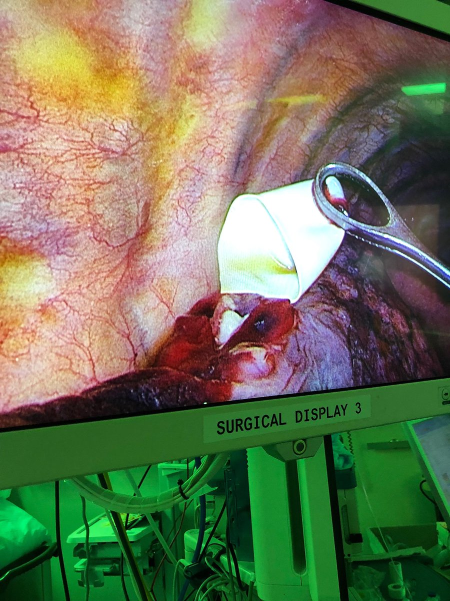 ElliotServaisMD's tweet image. Craziest thing I’ve seen in chest

Patient transferred to us after chest tube placed at outside ED for spon pneumothorax 1 week prior 

VATS for persistent air leak &amp;amp; found finger tip of glove embedded in lung

No prior chest procedures

ED procedure note - no issues noted
🤯