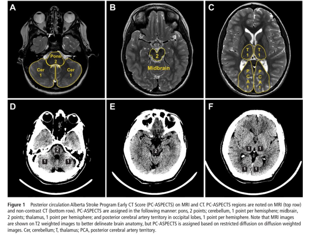 Focused update to guidelines for endovascular therapy for emergent large vessel occlusion: basilar artery occlusion patients  jnis.bmj.com/content/early/…