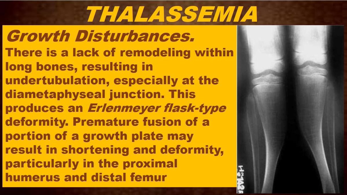 thalassaemia Quick review