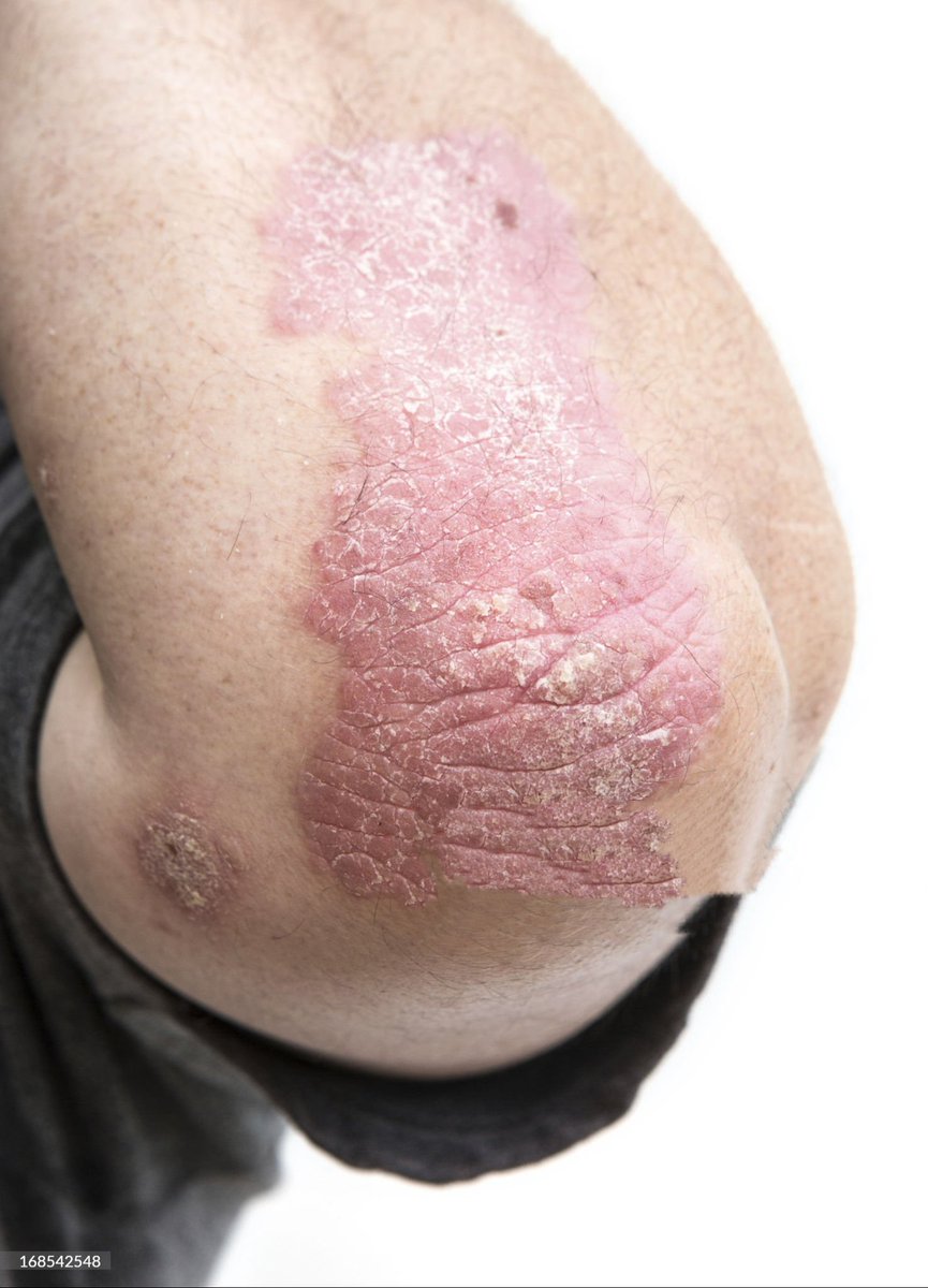 🟣𝘾𝙇𝙄𝙉𝙄𝘾𝘼𝙇 𝙎𝘾𝙀𝙉𝙀𝙍𝙄𝙊:-

📝Patient p/w dry scaly,itchy and inflamed patches of skin at elbow 

What is likely diagnosis ❓

#medx
#medEd
#medtwitter
