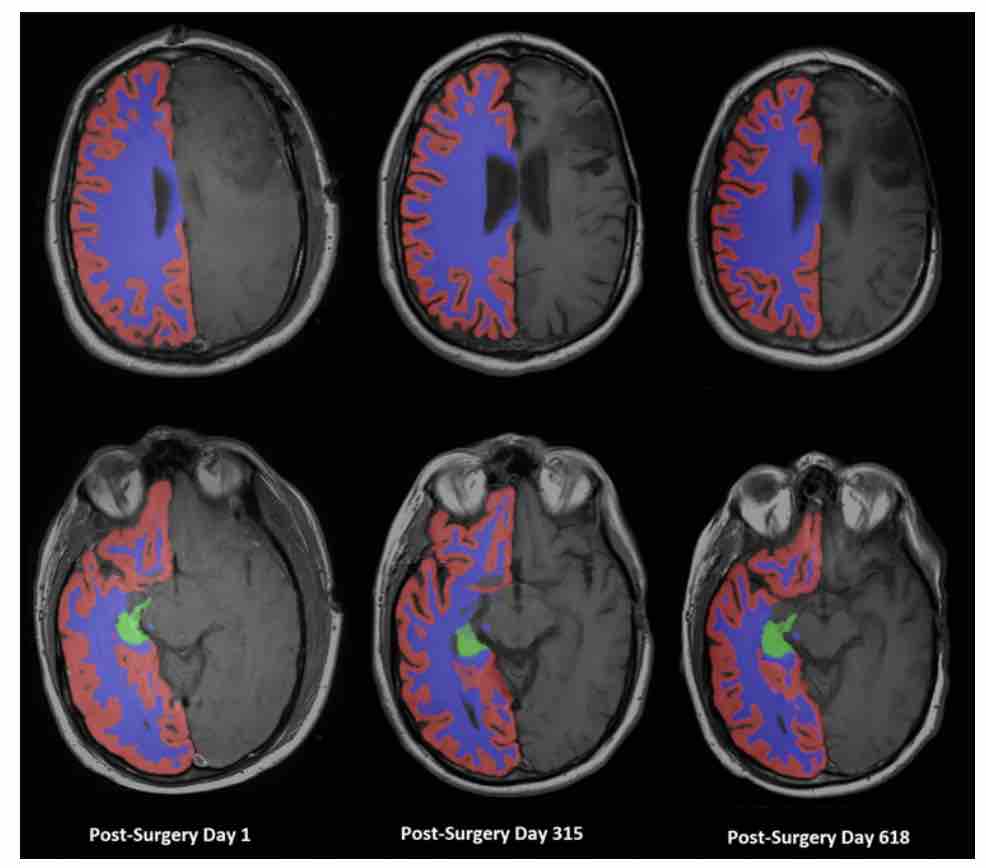 #OnlineFirst: Longitudinal brain volumetrics in glioma survivors. thejns.org/view/journals/….