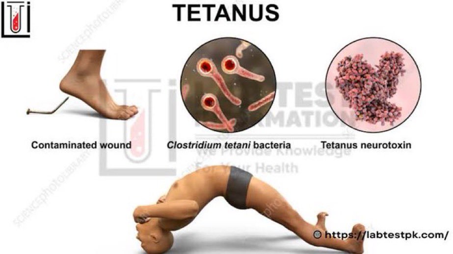 @fasc1nate Tetanus is unique in that it isn’t contagious, despite being an infection. The only way you can contract it is if the infected spores themselves come into contact with broken skin.

The bacterium Clostridium tetani, which causes tetanus, is found in the soil, feces, and…