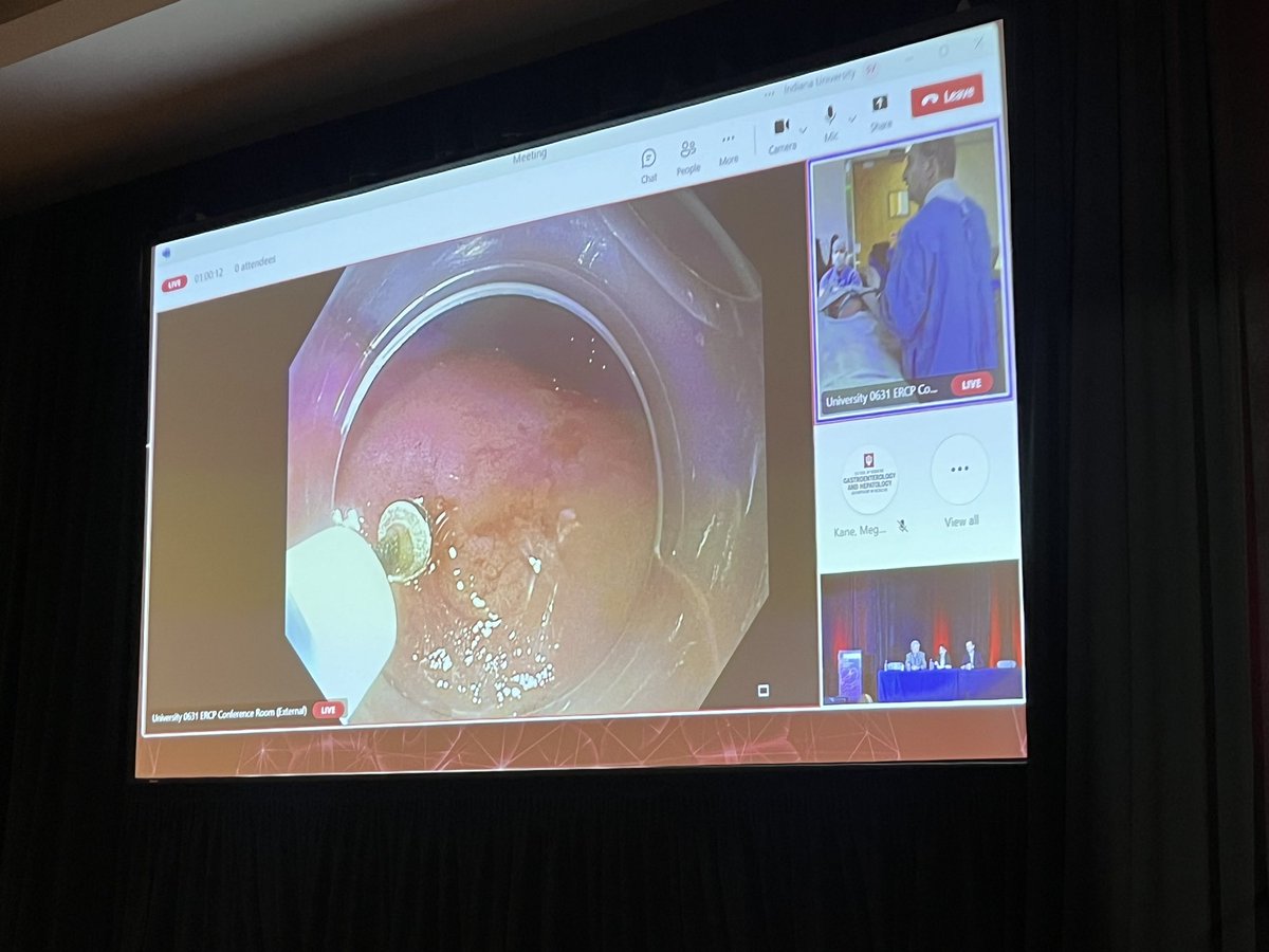 Another LIVE Endo session featuring third space endoscopy expert @alhaddad_mo and Dr. John DeWitt with POEM and GPOEM for tx of type 2 achalasia and gastroparesis. @IUGastro