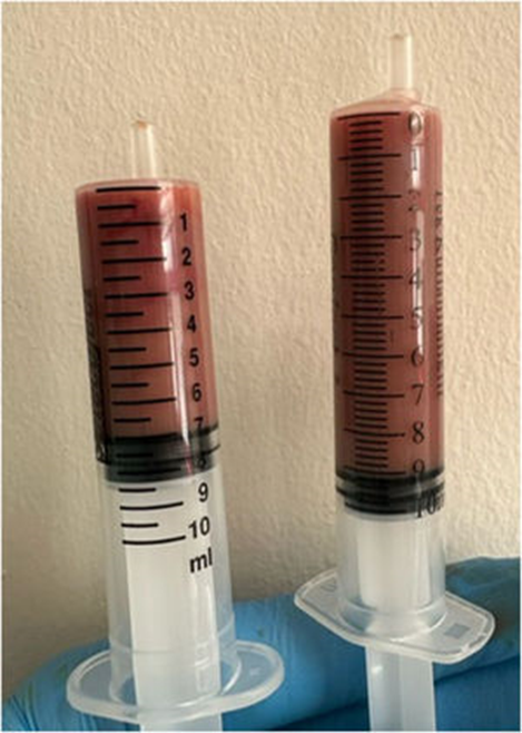 PCR for Bartonella spp. of aspirate:➕

CAT-SCRATCH DISEASE CAUSED BY BARTONELLA SPP., TRANSMITTED THROUGH FLEAS (not a direct cat scratch)

Azithromycin & drainage of the abscess: symptoms improved within 10 days & no recurrence for 3 months
2/3

#Medicine #idxposts