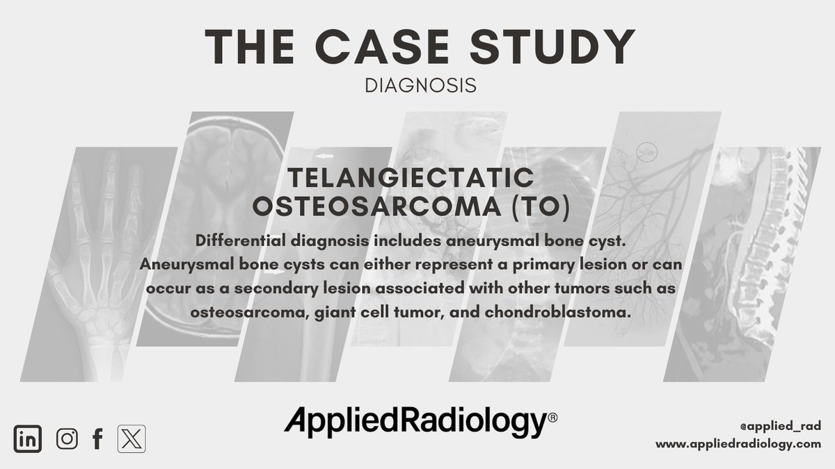 🩻 Case Study of the Week! Telangiectatic osteosarcoma (TO). Differential diagnosis includes aneurysmal bone cyst. See all the case details, more images, and diagnosis ➡️ bit.ly/3xNpVEV #RadEd #Radiology #CaseOfTheWeek #RadRes #CaseStudy