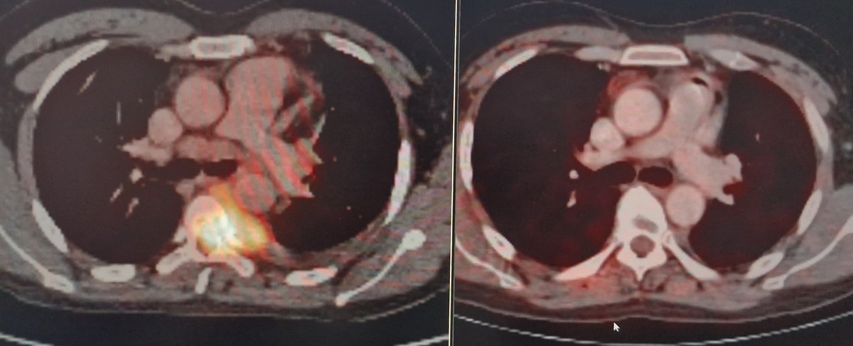 TCa D26 Sometimes #seminoma stays true to its nature and melts away dramatically after first line chemo..even spinal mets!! 😲😊 #TesticularCancerAwarenessMonth