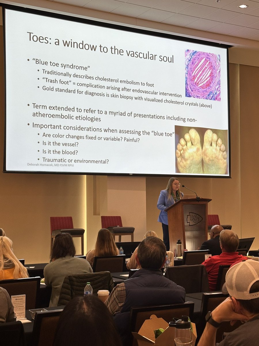 Thank you @ClevelandClinic for sharing Dr. Hornacek with us to learn more about examining blue toes #kcvascularsymposium2024 #bluetoes #vascular