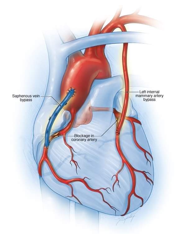 Coronary Artery Bypass Graft (CABG)
 It's a surgical procedure to improve blood flow to the heart by bypassing blocked or narrowed arteries using blood vessels from elsewhere in the body. It's commonly used to treat severe coronary artery disease.
#MedTwitter #MedX #MedEd