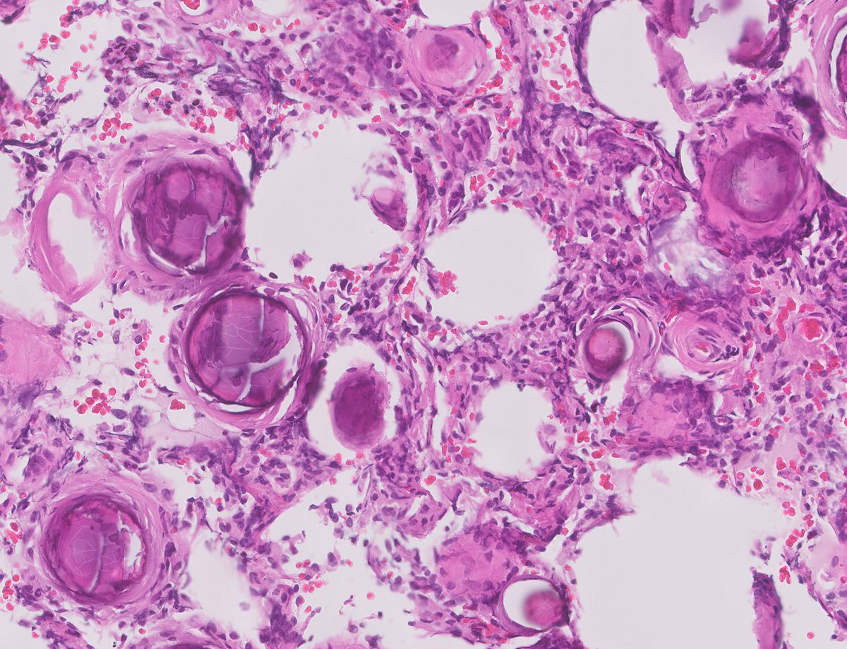 Too many 'stones' in this dural cervical lesion...

#neuropath #PathTwitter