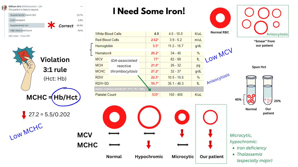 3:1 RULE VIOLATION

I posted a poll asking how you would treat a patient with a Hb 5.5 and Hct 20.2. The correct - and most popular - answer was iron. The clue is a violation in the 3:1 rule, which is another way of saying the MCHC is abnormal, in this case greatly decreased.