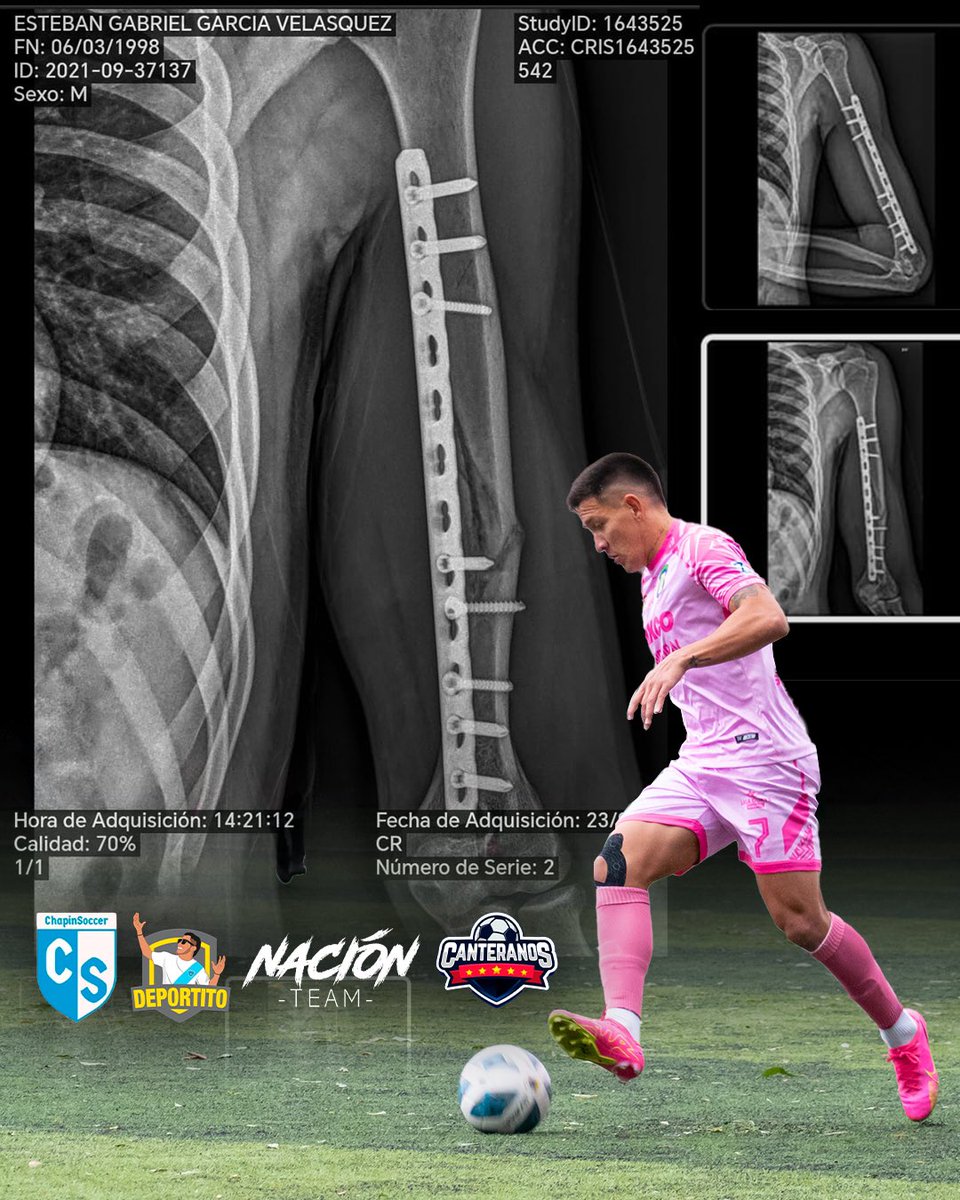 ASÍ MARCHA LA RECUPERACIÓN DE GABRIEL GARCÍA 🤕

En exclusiva te compartimos la radiografía del brazo de Gabriel García de Deportivo Mixco.

#VamosMixco #LigaGT #Clausura2024