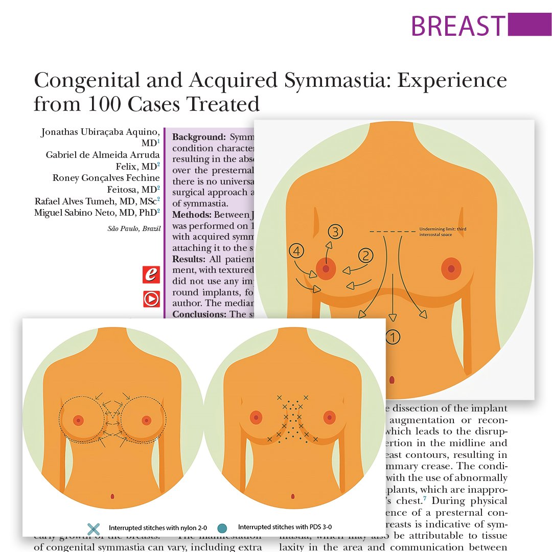 In this #PRSJournal study, the authors from São Paulo, Brazil, presents a surgical approach and preoperative and postoperative care for the correction of symmastia. Read more about it here bit.ly/CongenitalSymm…