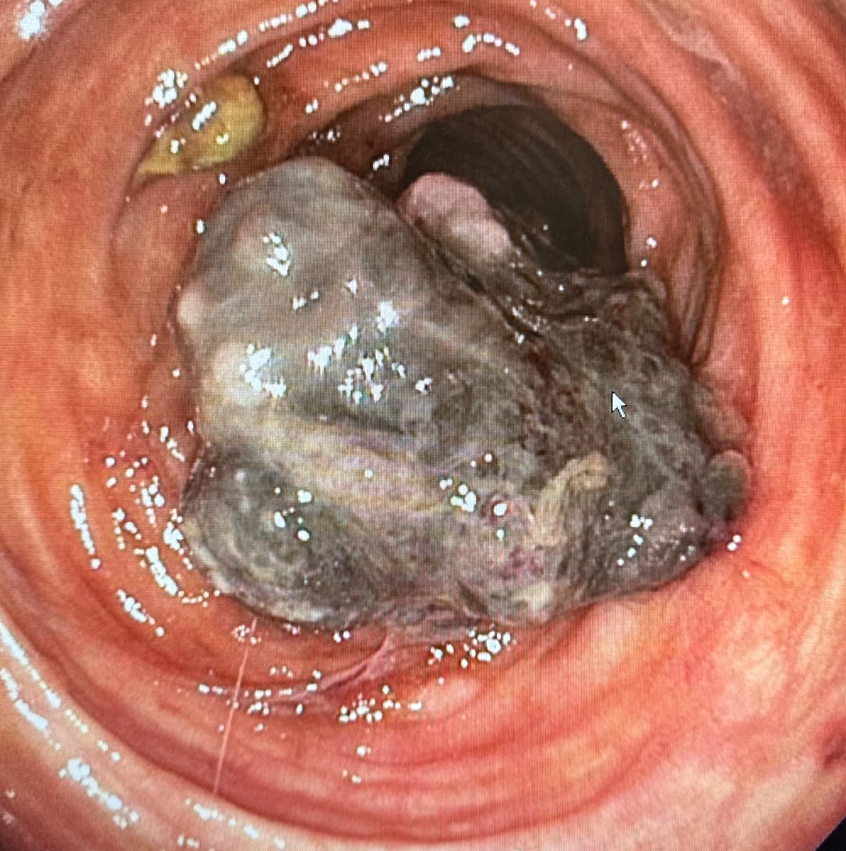 Patient with EGD/ Colon today. Interesting findings.