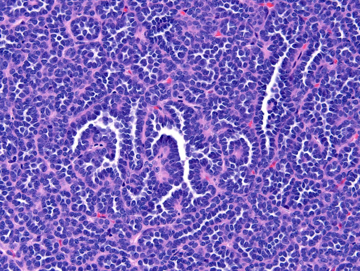 Metanephric adenoma is a rare, benign renal mass. Presenting laboratory findings may be polycythemia. These tumors are characterized by canonical BRAF V600E mutations and thought to arise from arrested embryonal rests. Histology is shown!