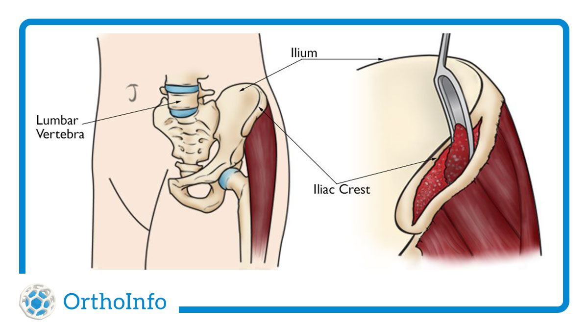 A #DonateLifeMonth fact from #OrthoInfo: 1 #tissuedonor helps more than 75 people. Donated tissue, including bone & bone cells, has many uses in orthopaedic surgery. Learn how it can help #fractures heal: bit.ly/4b5LD52 #Orthotwitter @DonateLife @otatrauma