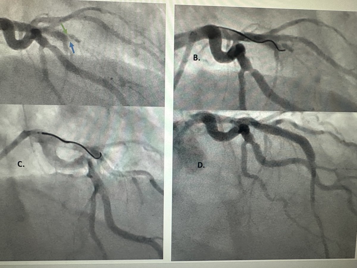 Five “G”eneral principles of successful PCI: 1. Good guide support 2. Good view(2 lumens (A), lower is false (B), aimed for upper. 3. Good angulations @ wire tip ( primary & secondary bends) & with MC (Twin pass or angled MC: used) 4: Good friend⁦@benhibbertMDPhD⁩ 5: God